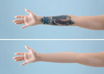 Tattoo Removal: Causes, Methods, and Considerations