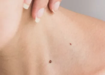 Mole Removal: Everything You Need to Know