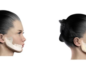 Chin Augmentation: Enhancing Facial Balance and Harmony