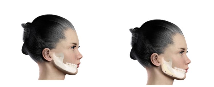 Chin Augmentation: Enhancing Facial Balance and Harmony