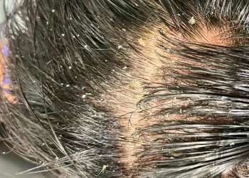 Care tips for oily scalp: refreshing and oil control