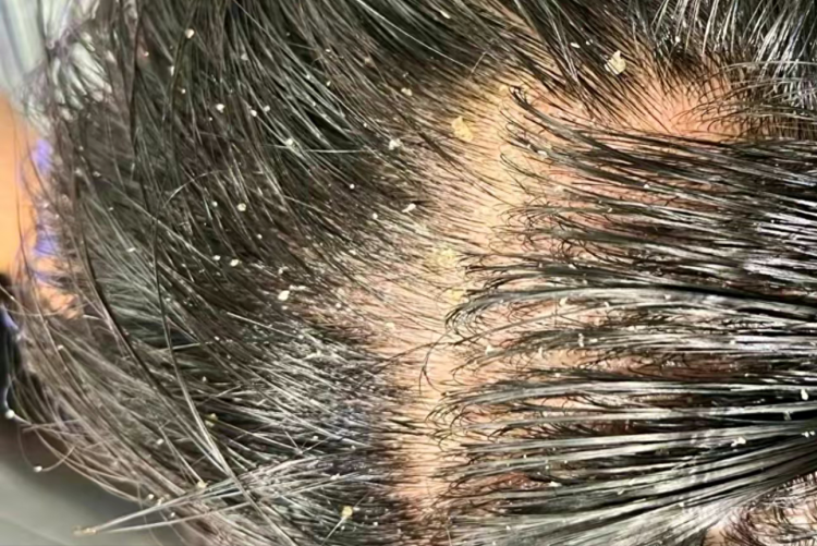 Care tips for oily scalp: refreshing and oil control