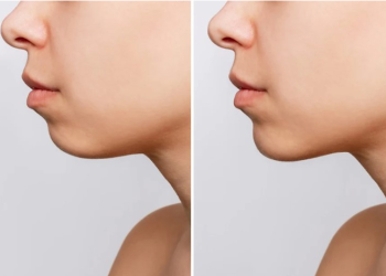Chin Reduction: Understanding the Procedure, Benefits, Risks, and Considerations