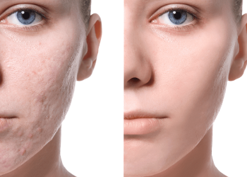 Can You Effectively Remove Scars Through Plastic Surgery?