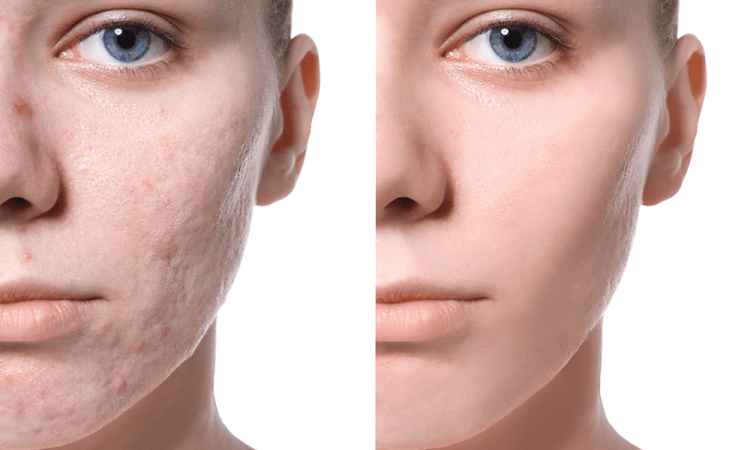 Can You Effectively Remove Scars Through Plastic Surgery?