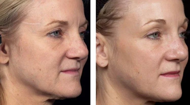 Thermage: A Comprehensive Guide to Non-Invasive Skin Tightening and Anti-Aging Treatment