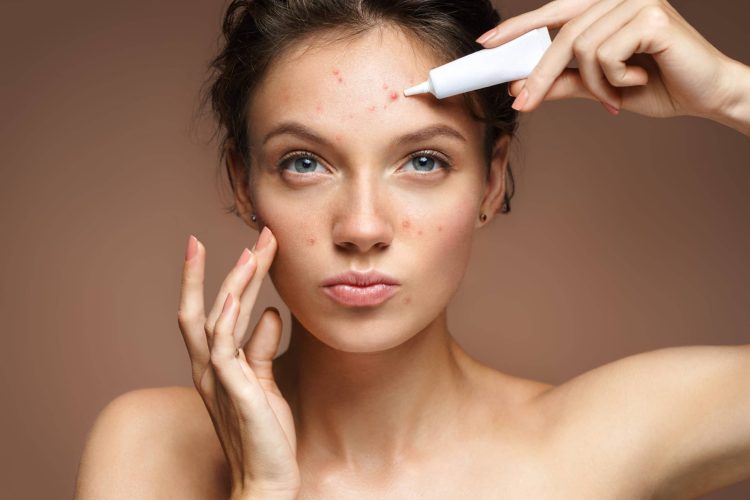 The Art of Popping Pimples: A Delicate Procedure