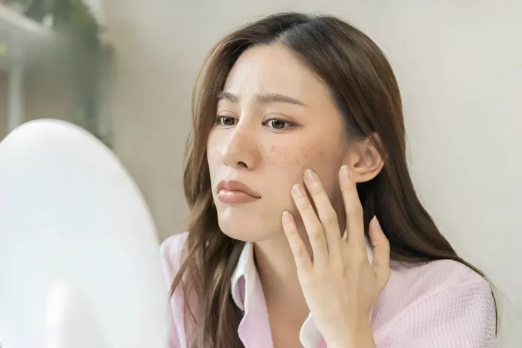 How Stress Affects Your Skin and Ways to Manage It