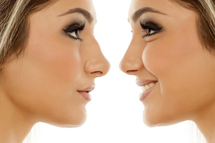 Rhinoplasty: Is the Nose Job Procedure Right for You?