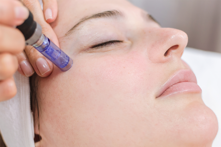 What’s the Real Impact of Microneedling on Your Skin?