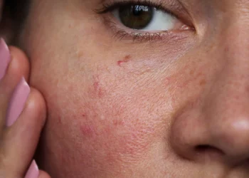 Can Sensitive Skin Use Skincare Products with Active Ingredients?