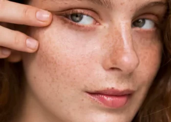 What Is the Principle Behind Laser Freckle Removal and Who Is It Suitable For?