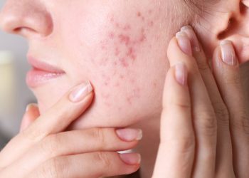 Could Your Diet Be Causing Your Breakouts?