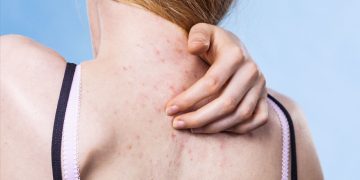 Is Your Active Lifestyle Helping Your Fitness But Hurting Your Skin?