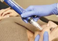 Microneedling: How Can Tiny Needles Revolutionize Your Skin?
