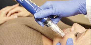 Microneedling: How Can Tiny Needles Revolutionize Your Skin?