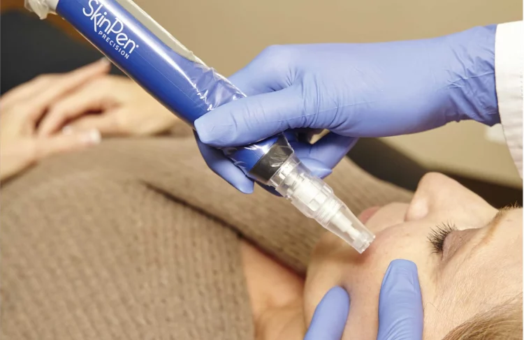 Microneedling: How Can Tiny Needles Revolutionize Your Skin?