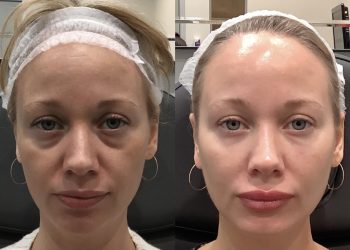 The Power of Partnership: Are Combination Aesthetic Treatments the Ultimate Path to Rejuvenation?