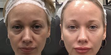 The Power of Partnership: Are Combination Aesthetic Treatments the Ultimate Path to Rejuvenation?