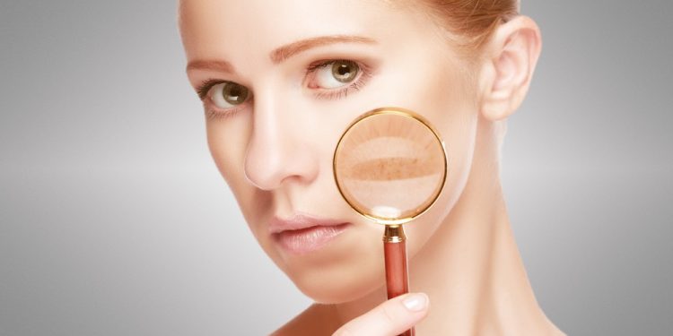 How Can You Effectively Treat Post-Inflammatory Hyperpigmentation and Prevent Future Spots?
