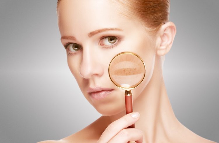 How Can You Effectively Treat Post-Inflammatory Hyperpigmentation and Prevent Future Spots?