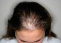 The Growing Trend of Scalp Micro-Pigmentation: Is This the Ultimate Solution for Hair Loss?