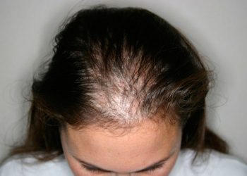The Growing Trend of Scalp Micro-Pigmentation: Is This the Ultimate Solution for Hair Loss?