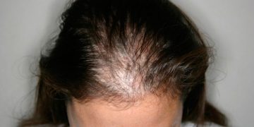 The Growing Trend of Scalp Micro-Pigmentation: Is This the Ultimate Solution for Hair Loss?