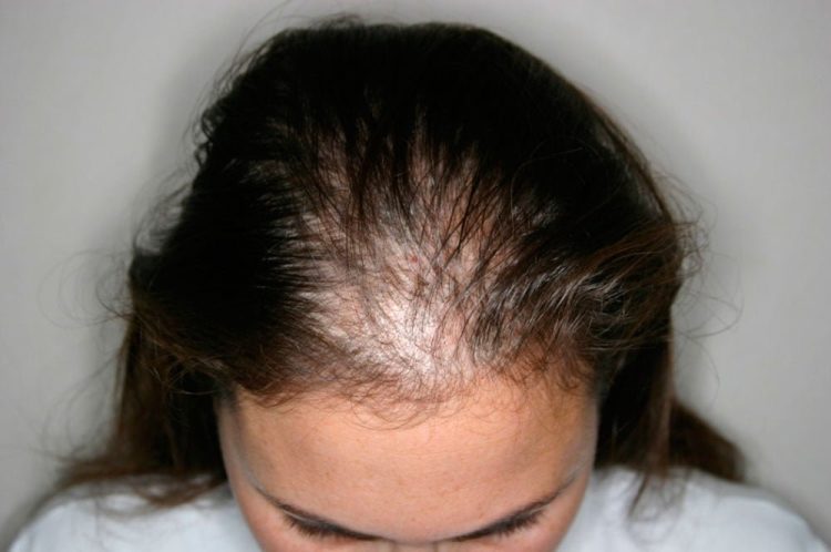 The Growing Trend of Scalp Micro-Pigmentation: Is This the Ultimate Solution for Hair Loss?