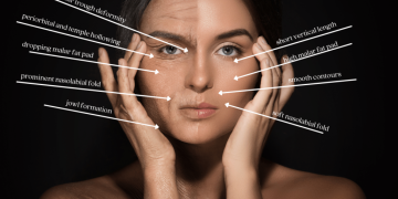 What Should You Know About Non-Surgical Cheek Augmentation Before Choosing It?