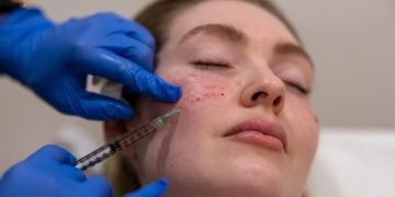 How Does PRP Enhance Modern Hair and Skin Treatments?