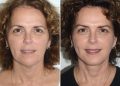 The Non-Surgical Brow Lift: Can You Truly Lift Your Brows Without Surgery?