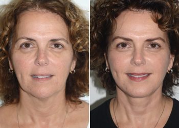 The Non-Surgical Brow Lift: Can You Truly Lift Your Brows Without Surgery?