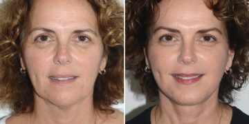 The Non-Surgical Brow Lift: Can You Truly Lift Your Brows Without Surgery?