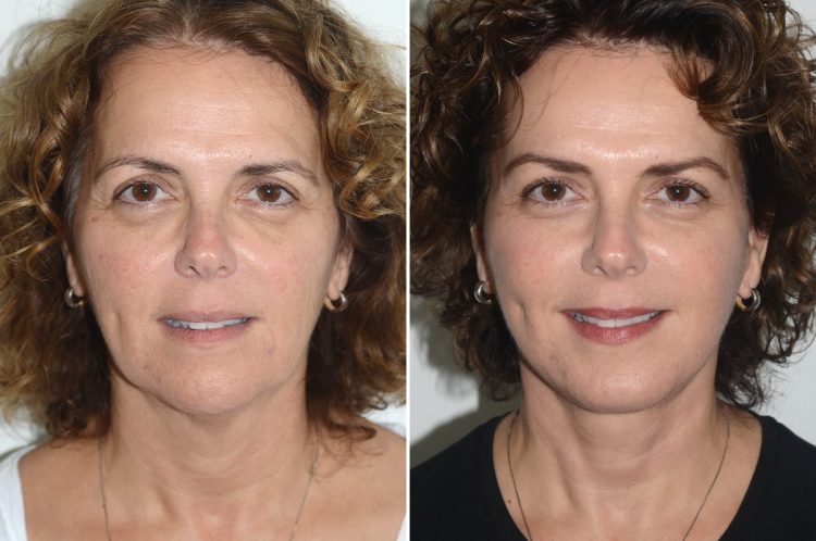 The Non-Surgical Brow Lift: Can You Truly Lift Your Brows Without Surgery?