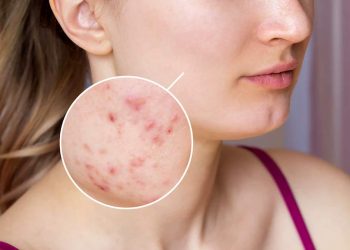 How Can You Achieve Flawless Foundation for Oily Skin That Lasts All Day?