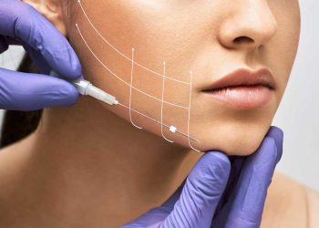 Is Thread Lifting a Safe Alternative to Facelift Surgery?