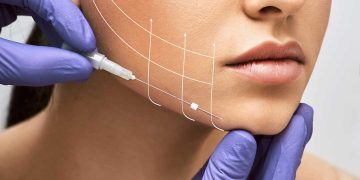 Is Thread Lifting a Safe Alternative to Facelift Surgery?