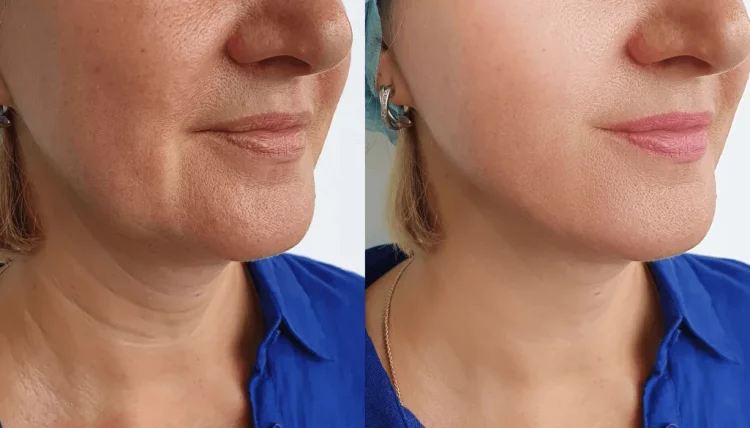 The Neglected Frontier: Why Your Neck Demands a Specialized Rejuvenation Strategy