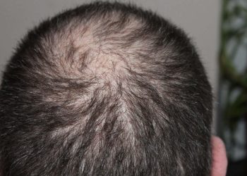 Can Stress Actually Cause Hair Loss?