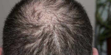 Can Stress Actually Cause Hair Loss?