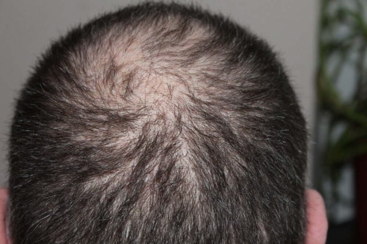 Can Stress Actually Cause Hair Loss?