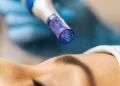 From Needles to Nanotech: The Evolution of Skin Rejuvenation Treatments