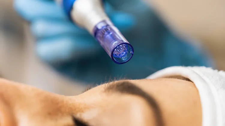 From Needles to Nanotech: The Evolution of Skin Rejuvenation Treatments